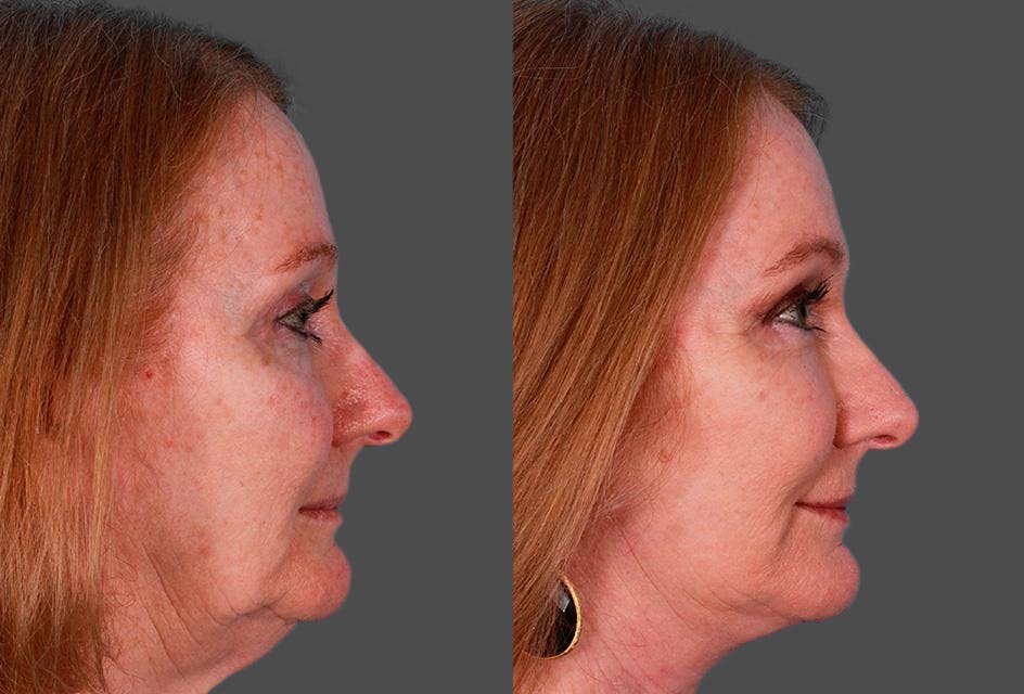 Facelift Before & After Gallery - Patient 181414 - Image 3