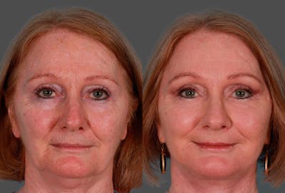 Facelift Before & After Gallery - Patient 181414 - Image 1