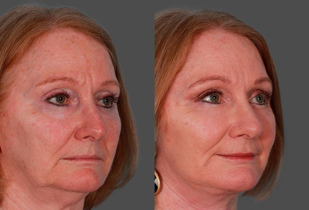 Facelift Before & After Gallery - Patient 181414 - Image 2