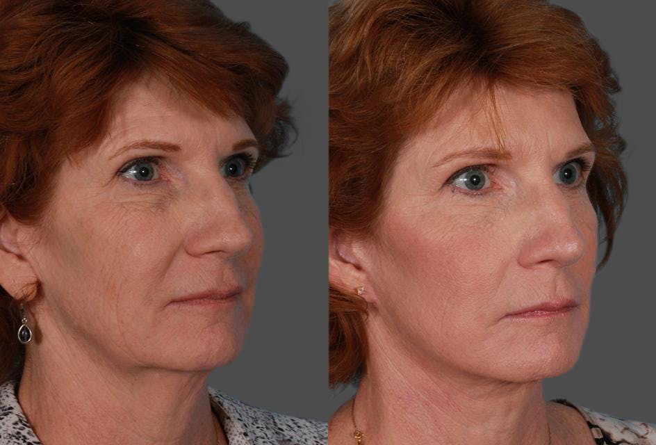 Facelift Before & After Gallery - Patient 179100 - Image 2