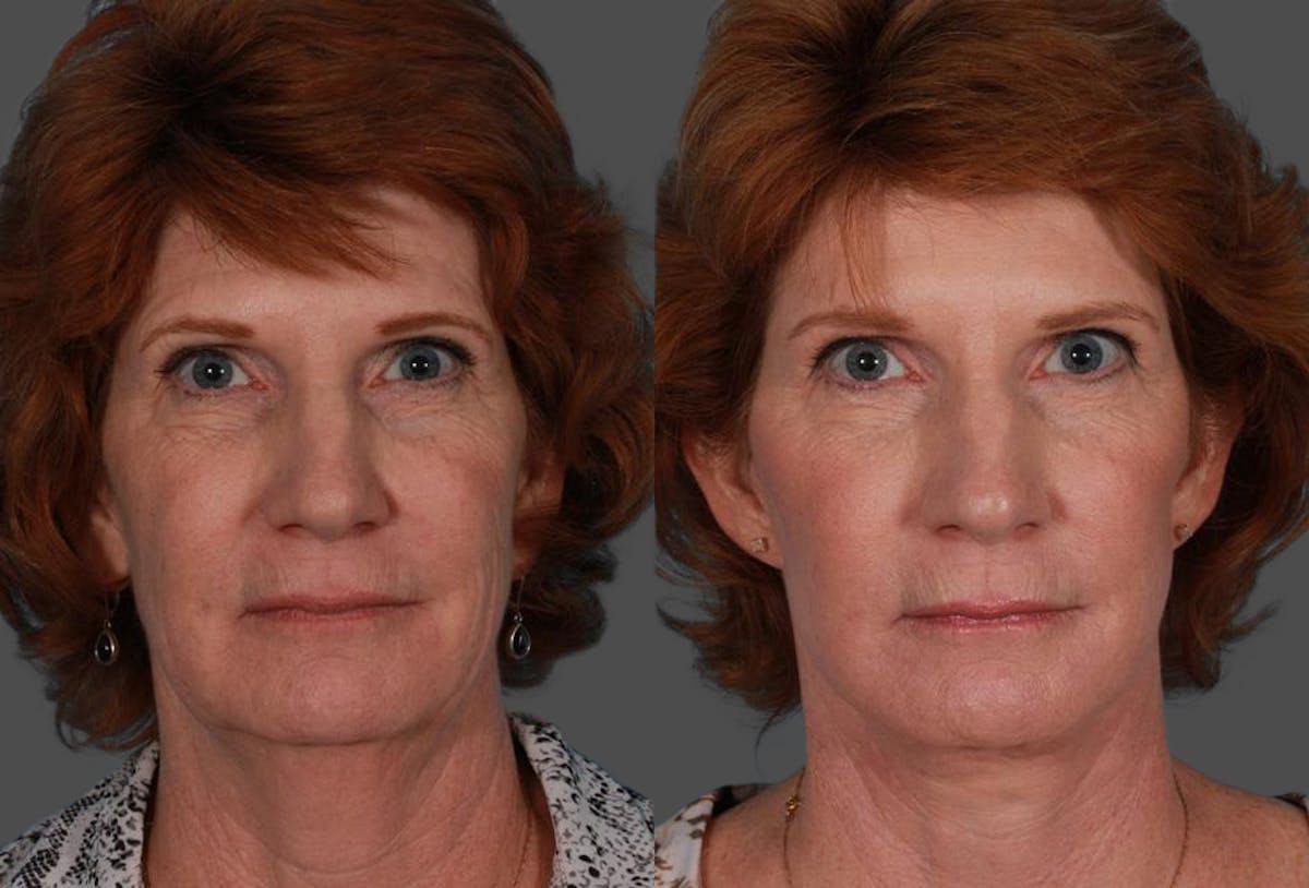 Facelift Before & After Gallery - Patient 179100 - Image 1
