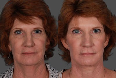 Facelift Before & After Gallery - Patient 179100 - Image 1