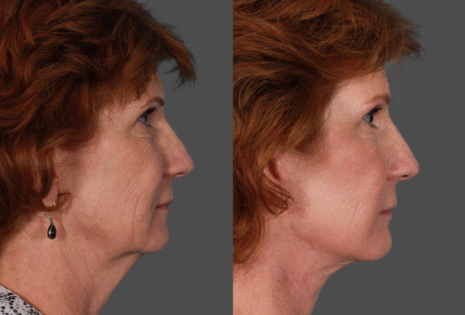 Facelift Before & After Gallery - Patient 179100 - Image 3