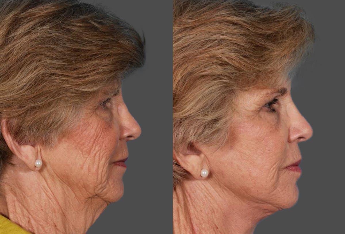 Facelift Before & After Gallery - Patient 177184 - Image 3