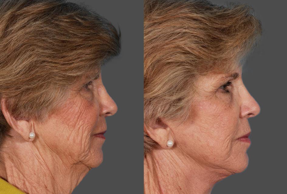 Facelift Before & After Gallery - Patient 177184 - Image 3