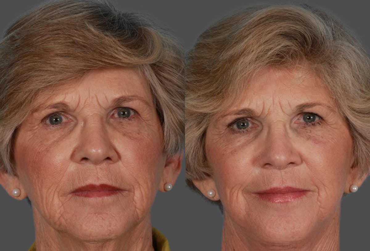 Facelift Before & After Gallery - Patient 177184 - Image 1