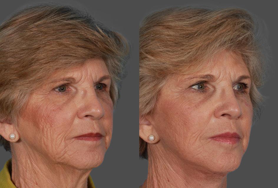 Facelift Before & After Gallery - Patient 177184 - Image 2