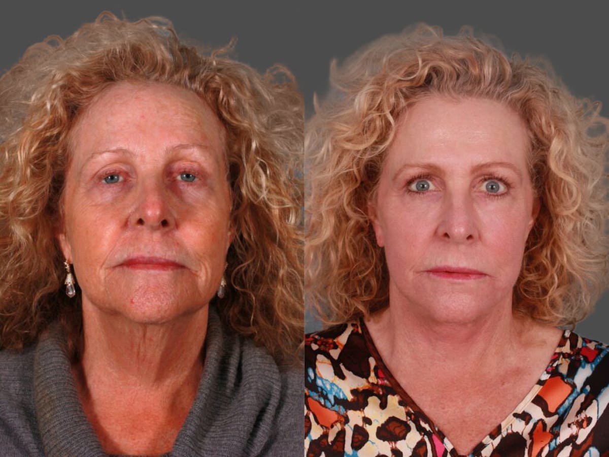 Facelift Before & After Gallery - Patient 243413 - Image 1