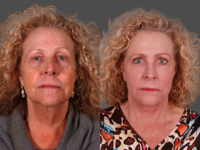 Facelift Before & After Gallery - Patient 243413 - Image 1