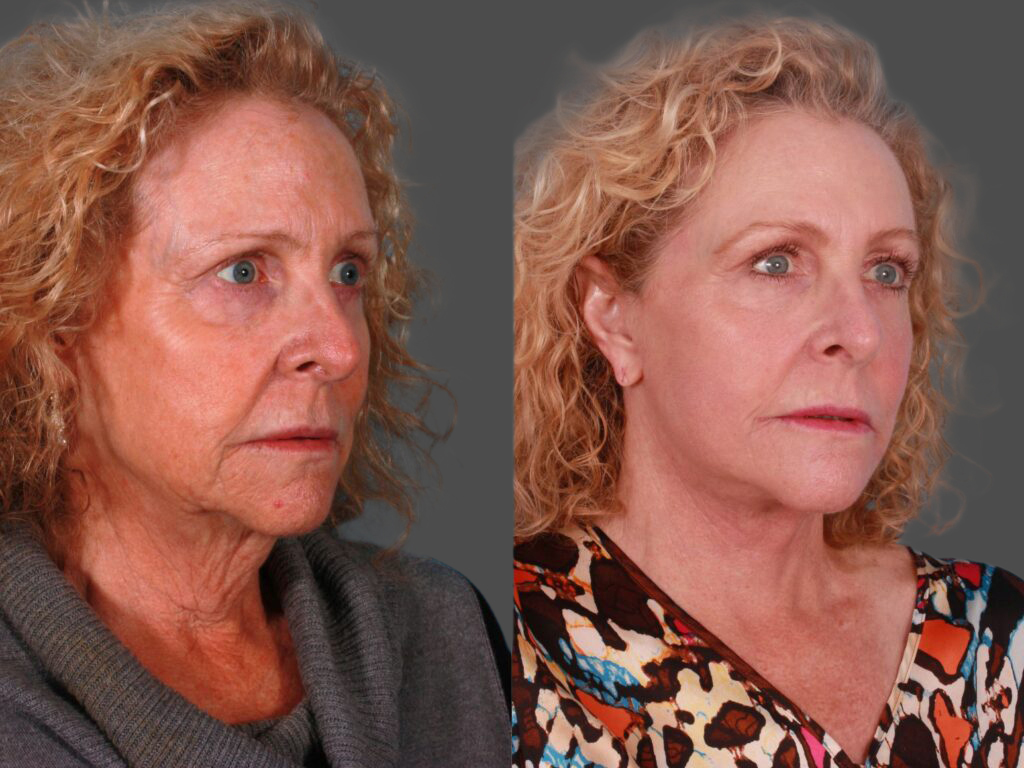 Patient 243413 | Facelift Before & After Photos | Buckingham