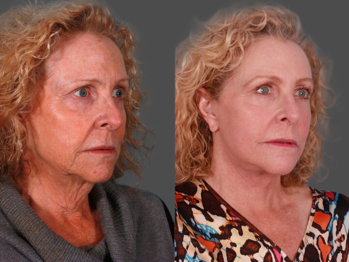 Facelift Before & After Gallery - Patient 243413 - Image 2