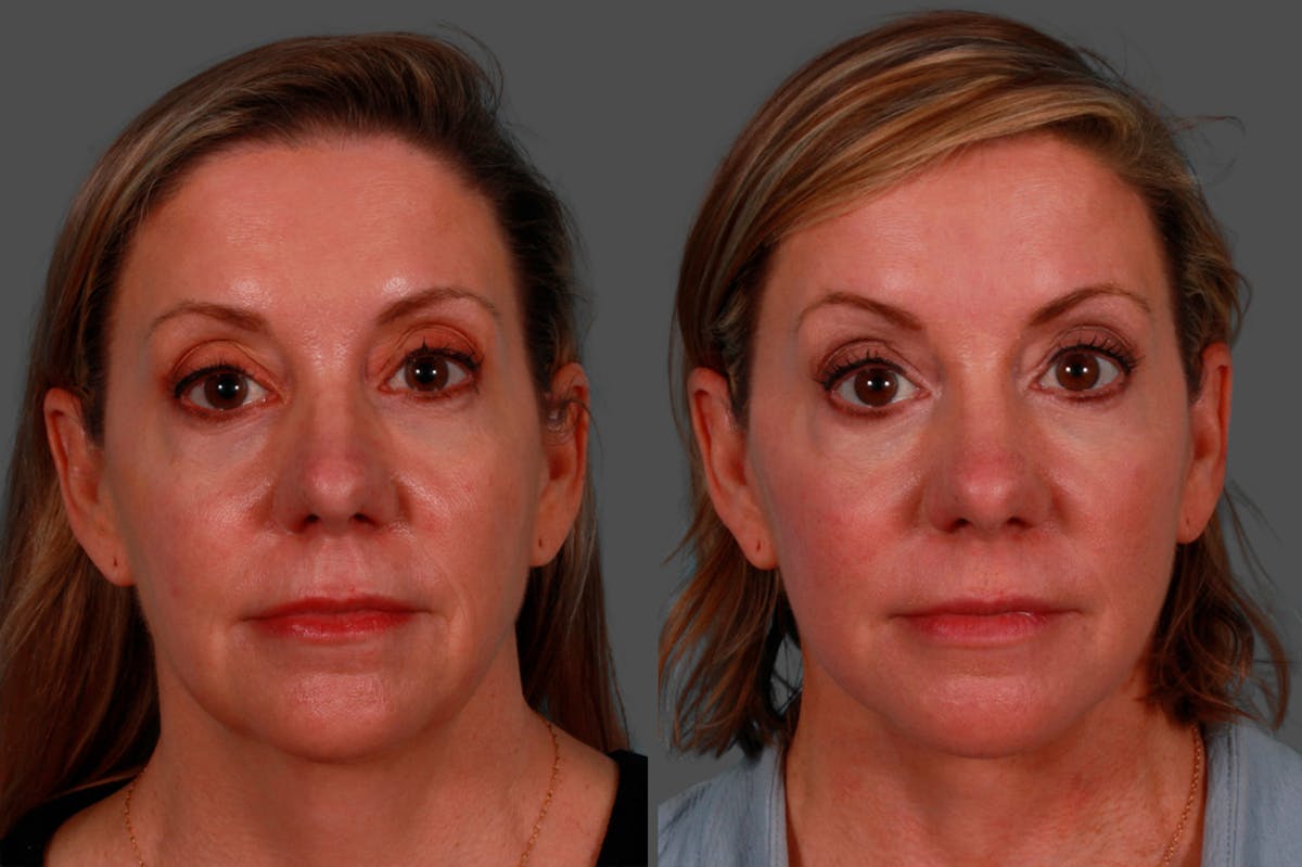 Facelift Before & After Gallery - Patient 234969 - Image 1
