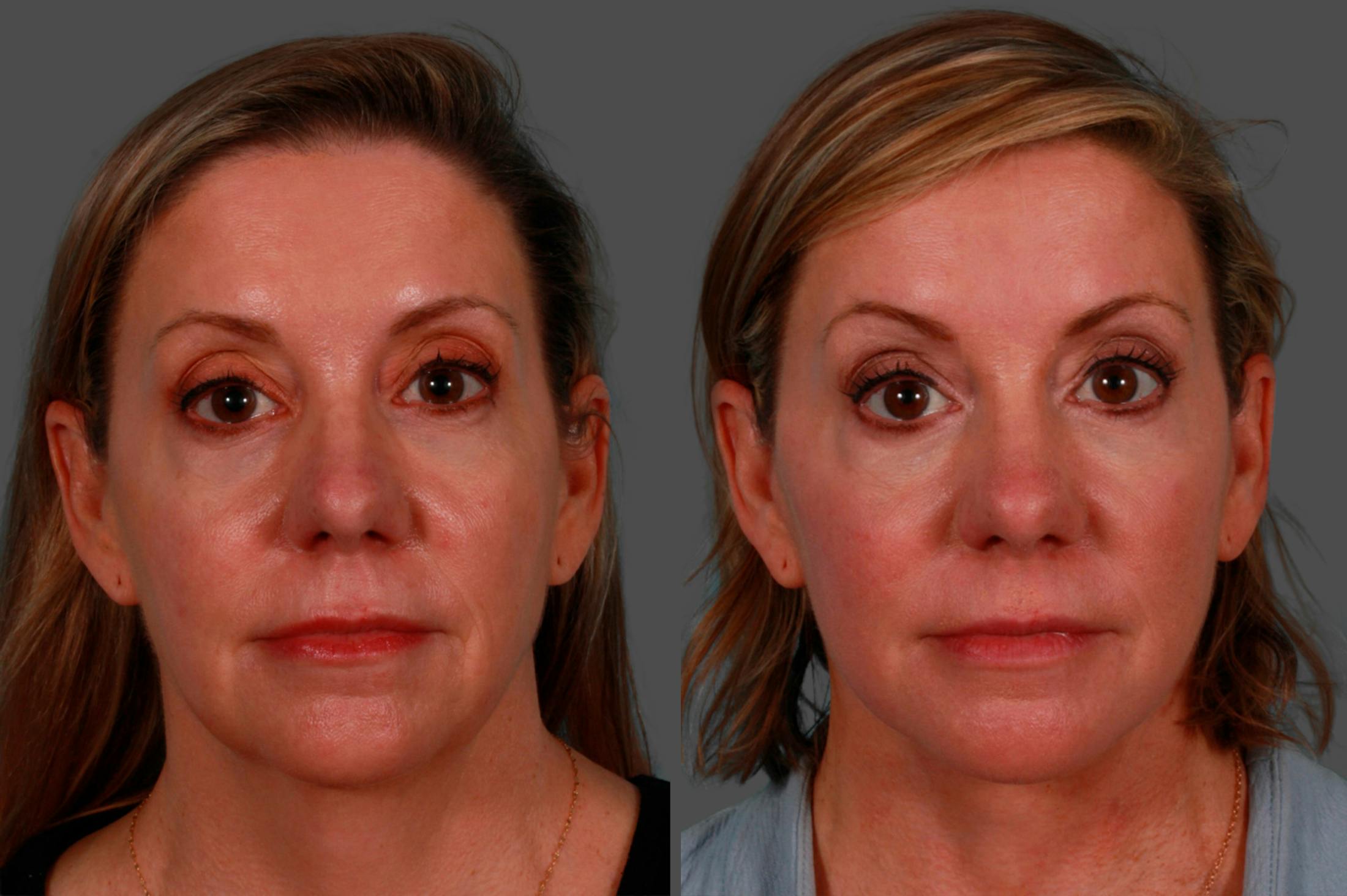 Facelift Before & After Gallery - Patient 234969 - Image 1