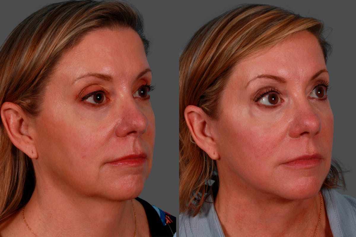 Facelift Before & After Gallery - Patient 234969 - Image 2