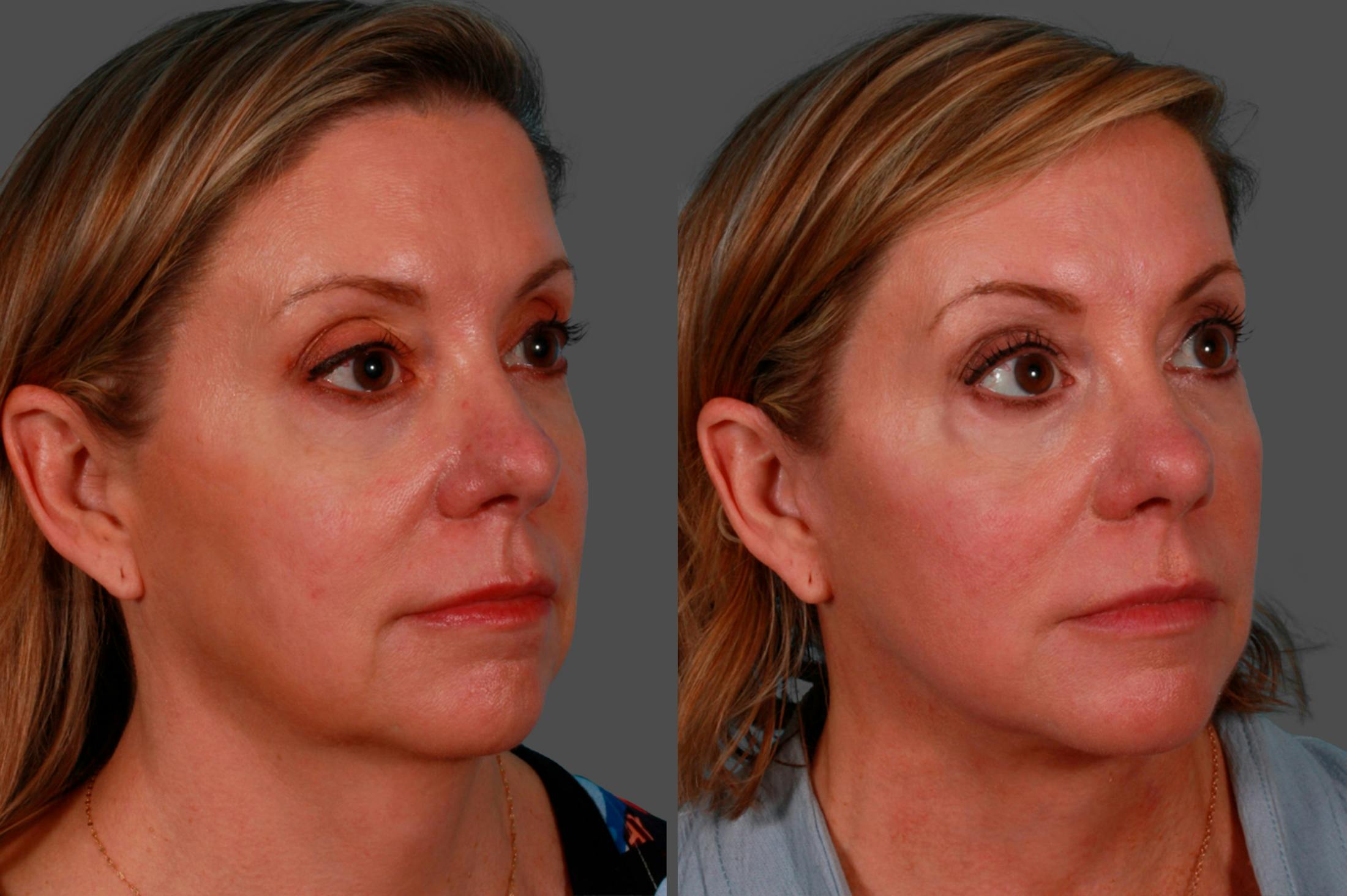 Facelift Before & After Gallery - Patient 234969 - Image 2
