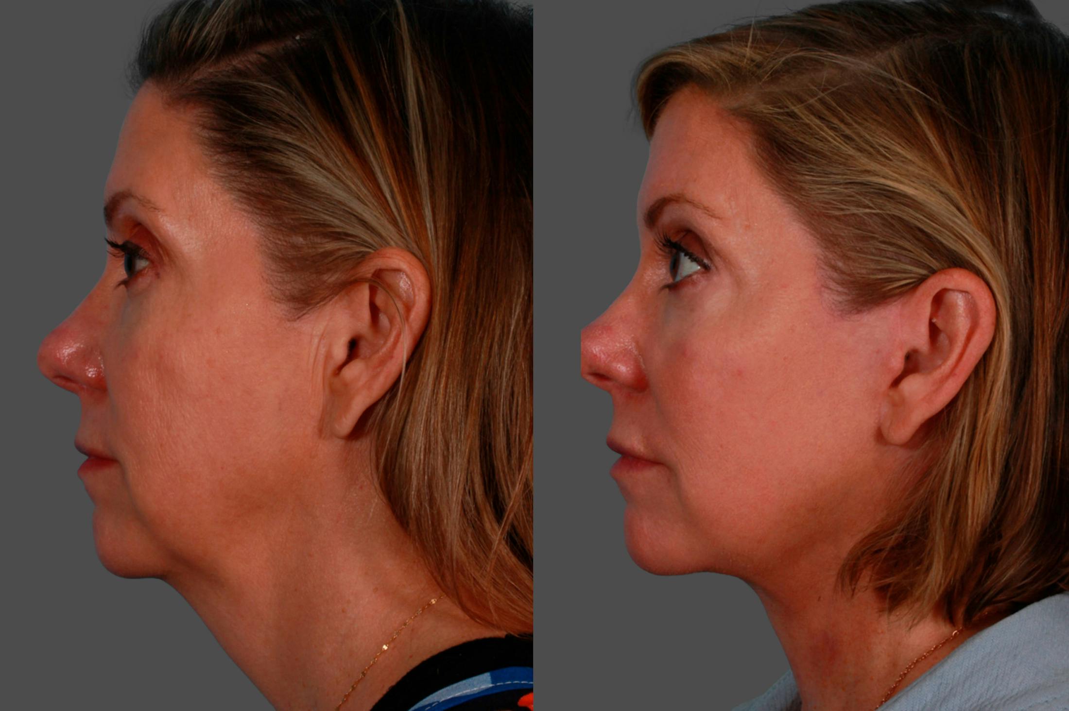 Facelift Before & After Gallery - Patient 234969 - Image 3