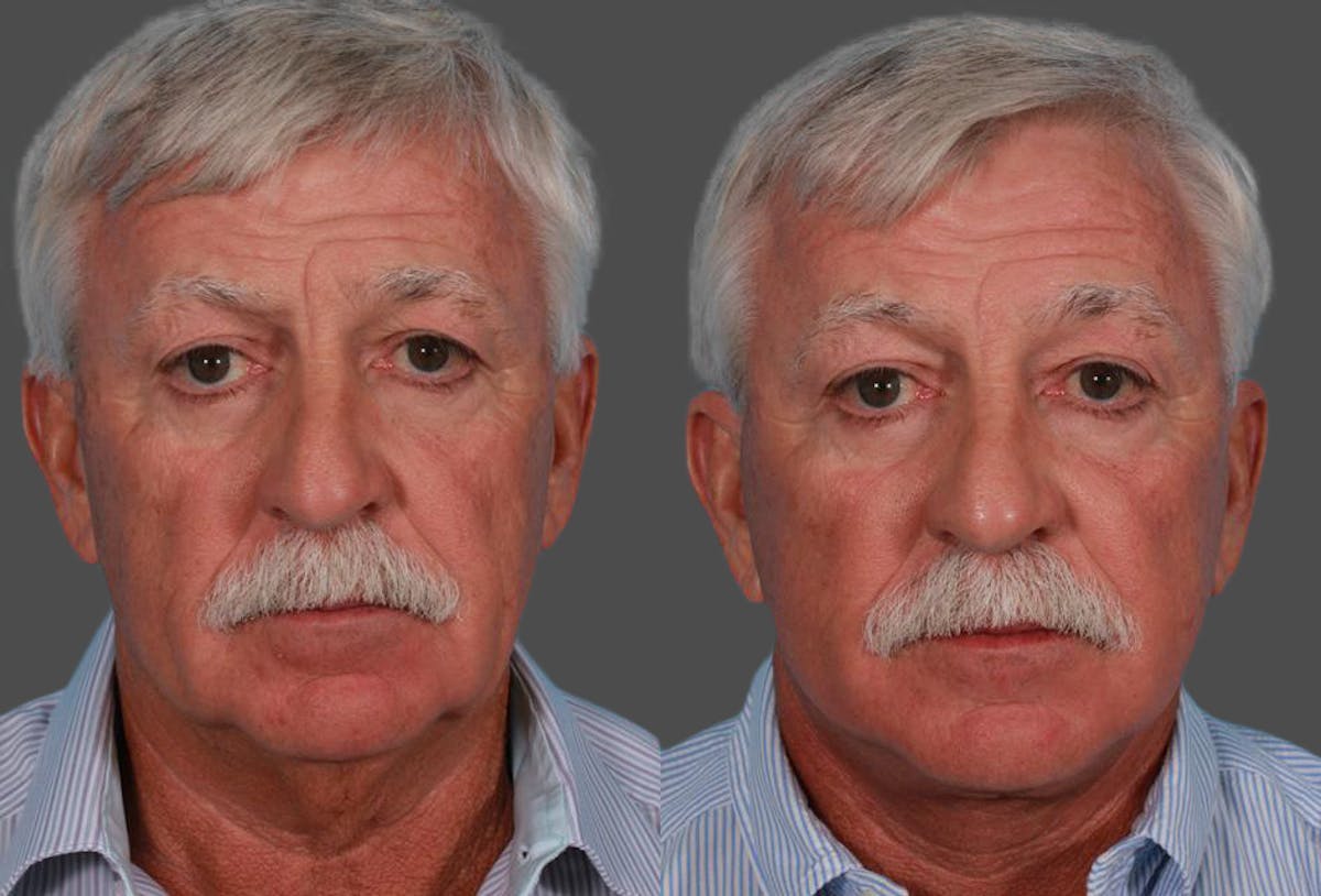 Facelift Before & After Gallery - Patient 229363 - Image 1