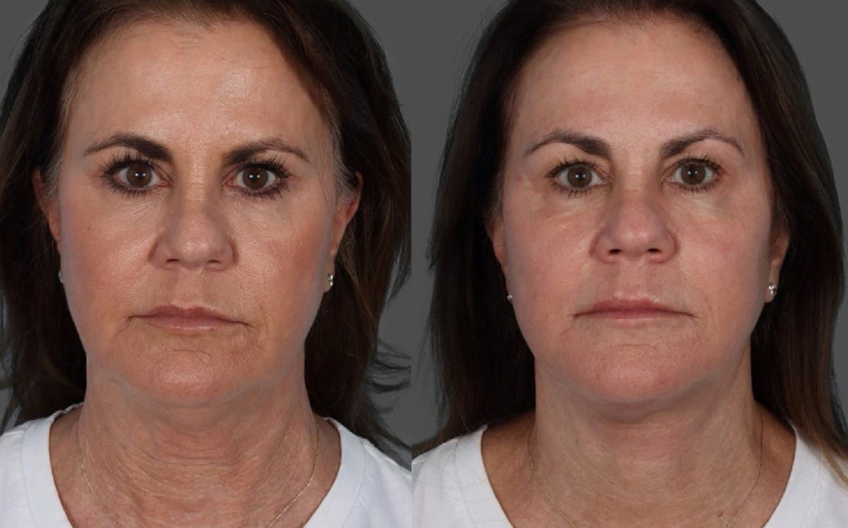 Facelift Before & After Gallery - Patient 228279 - Image 1
