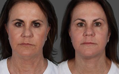 Facelift Before & After Gallery - Patient 228279 - Image 1
