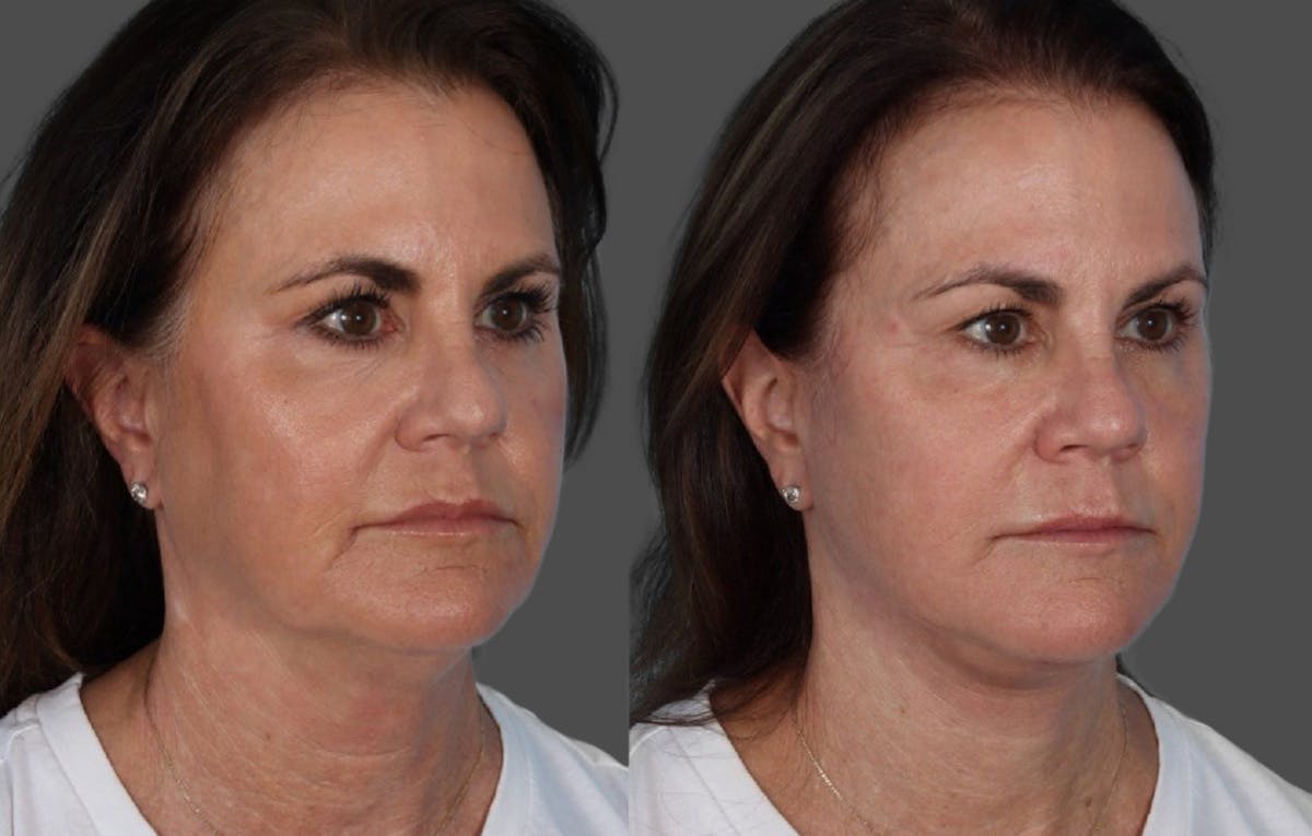 Facelift Before & After Gallery - Patient 228279 - Image 2