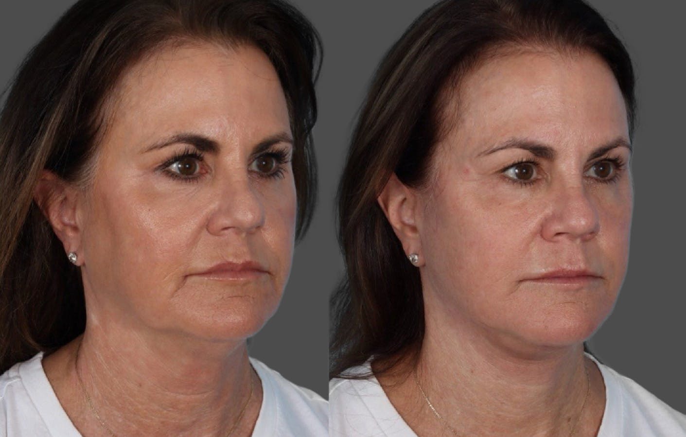 Facelift Before & After Gallery - Patient 228279 - Image 2