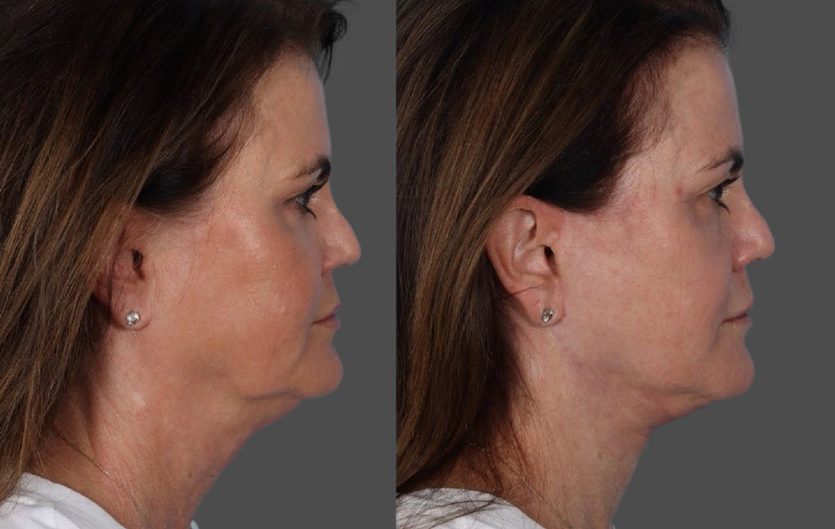 Facelift Before & After Gallery - Patient 228279 - Image 3