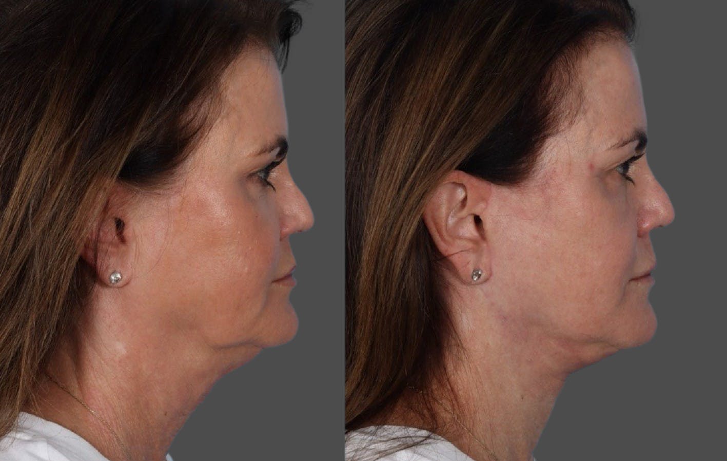 Facelift Before & After Gallery - Patient 228279 - Image 3
