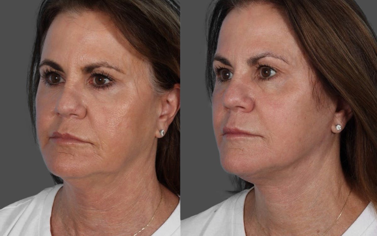 Facelift Before & After Gallery - Patient 228279 - Image 4