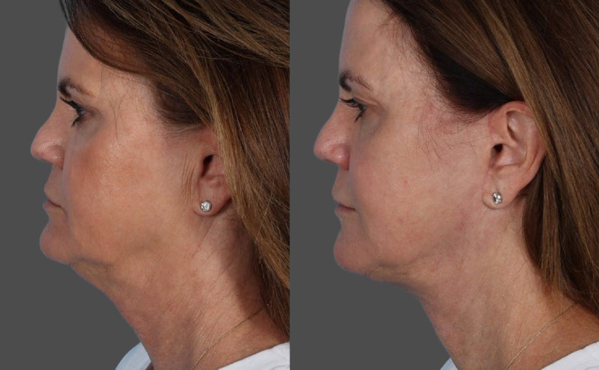 Facelift Before & After Gallery - Patient 228279 - Image 5