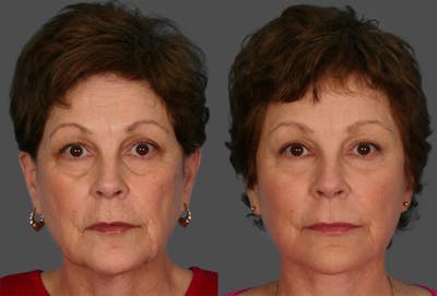 Facelift Before & After Gallery - Patient 209929 - Image 1