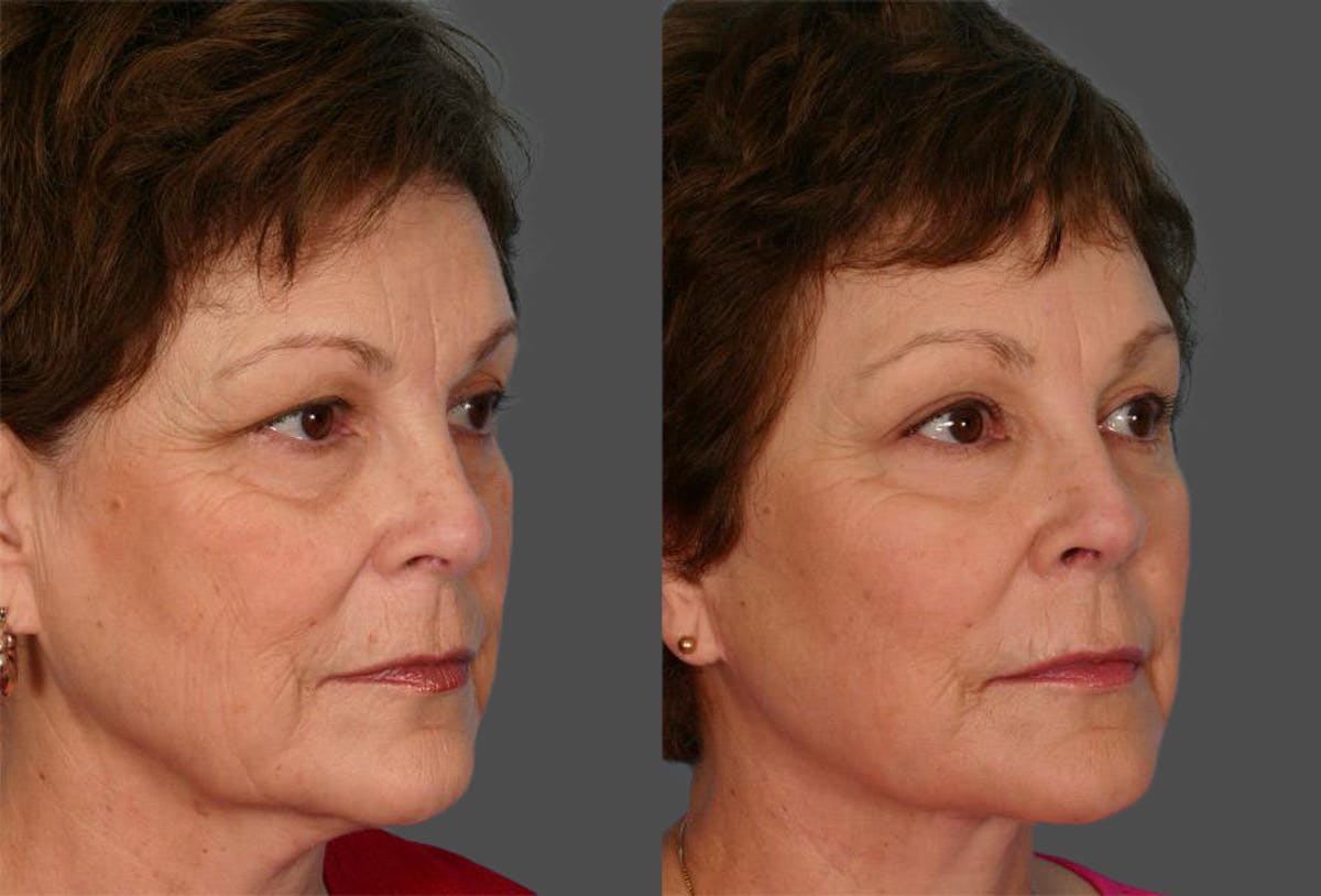 Facelift Before & After Gallery - Patient 209929 - Image 2