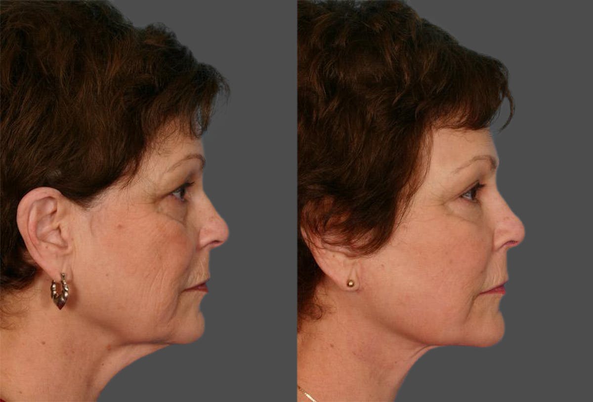 Facelift Before & After Gallery - Patient 209929 - Image 3