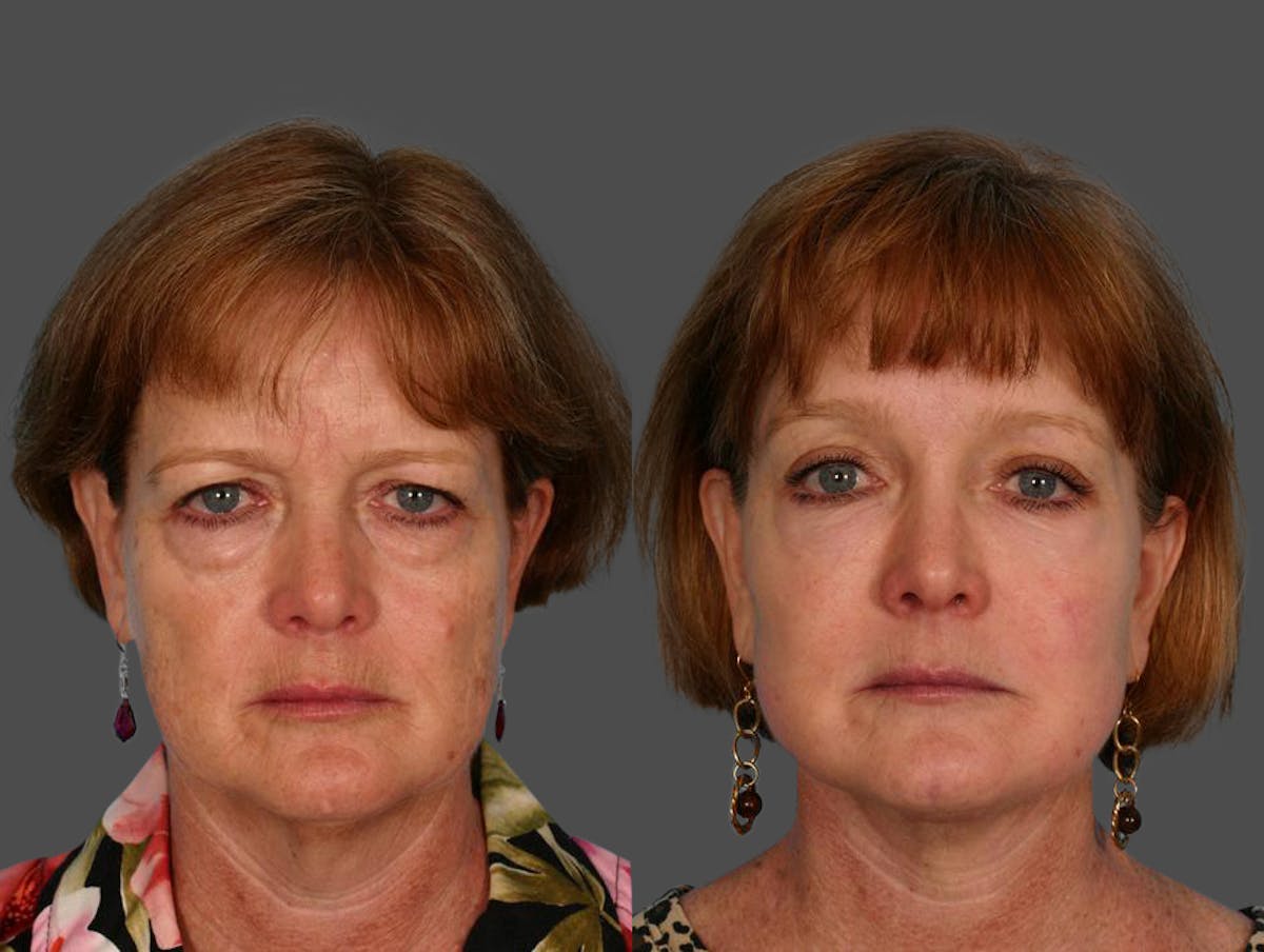 Facial Fat Transfer Before & After Gallery - Patient 218299 - Image 1