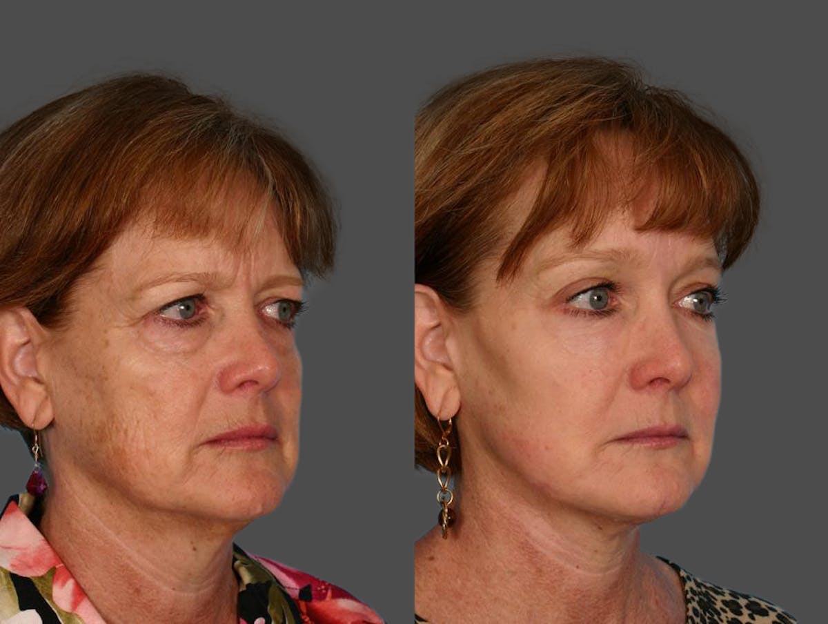 Facial Fat Transfer Before & After Gallery - Patient 218299 - Image 2