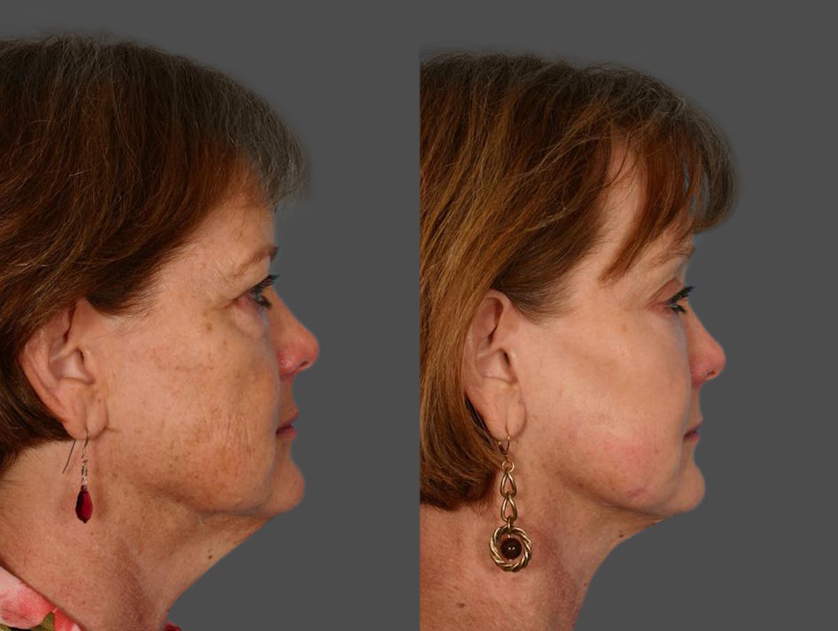 Facial Fat Transfer Before & After Gallery - Patient 218299 - Image 3