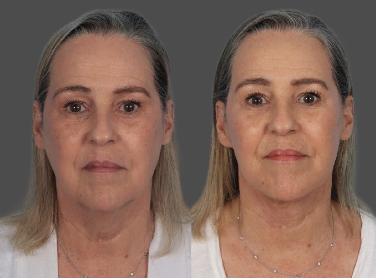 Facelift Before & After Gallery - Patient 290124 - Image 1