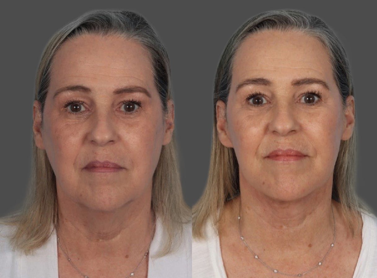 Facelift Before & After Gallery - Patient 290124 - Image 1