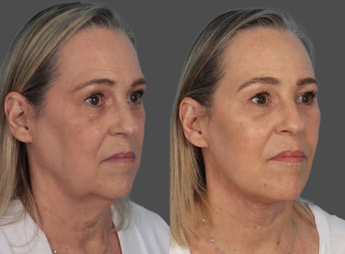 Facelift Before & After Gallery - Patient 290124 - Image 2