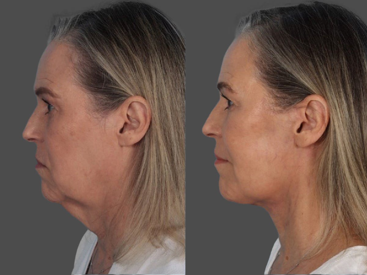 Facelift Before & After Gallery - Patient 290124 - Image 3