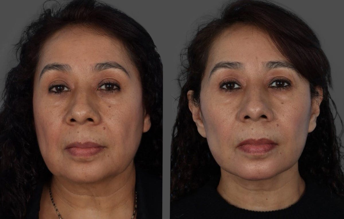 Facelift Before & After Gallery - Patient 268602 - Image 1