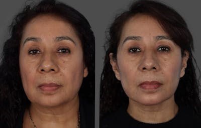 Facelift Before & After Gallery - Patient 268602 - Image 1