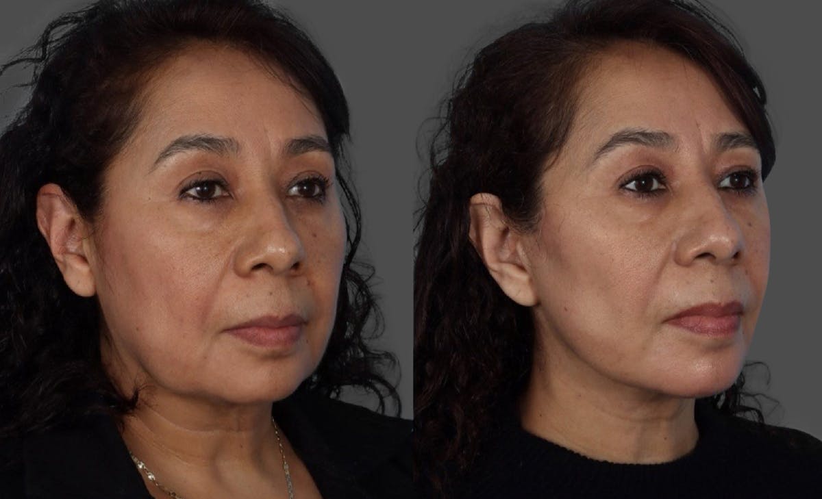 Facelift Before & After Gallery - Patient 268602 - Image 2