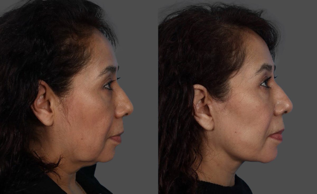 Facelift Before & After Gallery - Patient 268602 - Image 5