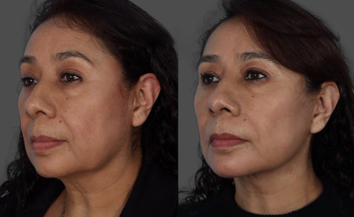 Facelift Before & After Gallery - Patient 268602 - Image 4