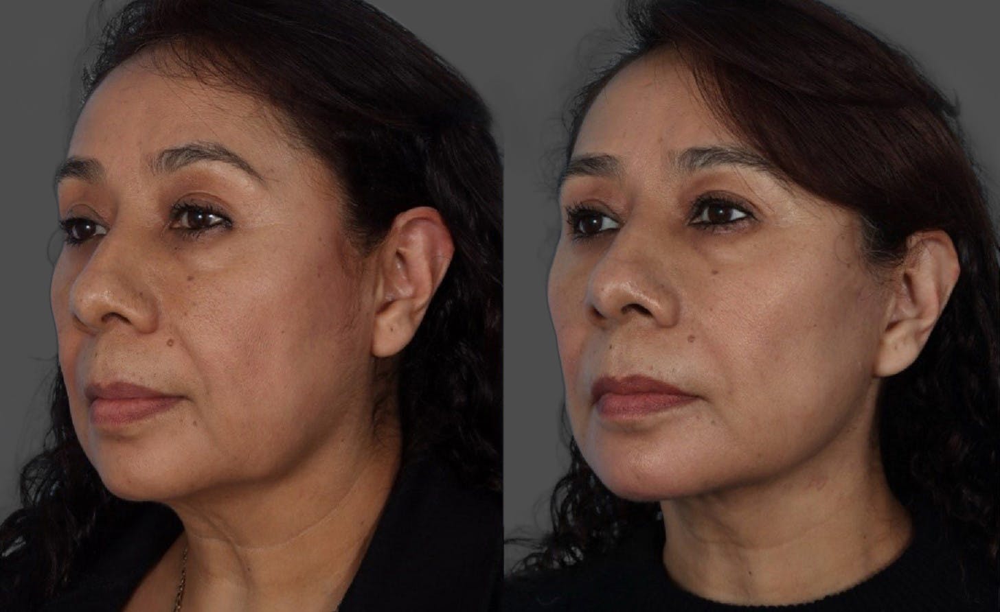 Facelift Before & After Gallery - Patient 268602 - Image 4