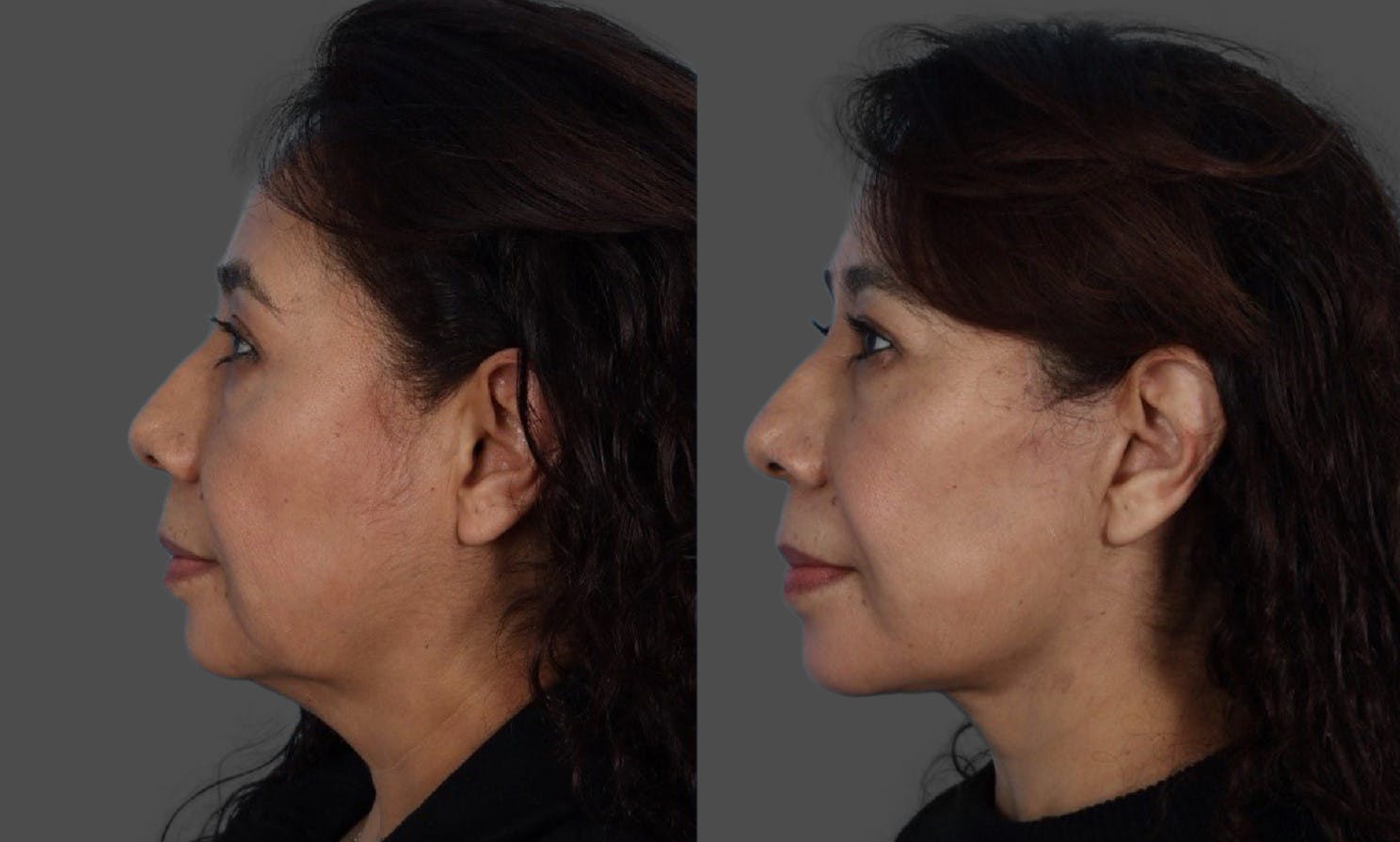 Facelift Before & After Gallery - Patient 268602 - Image 3
