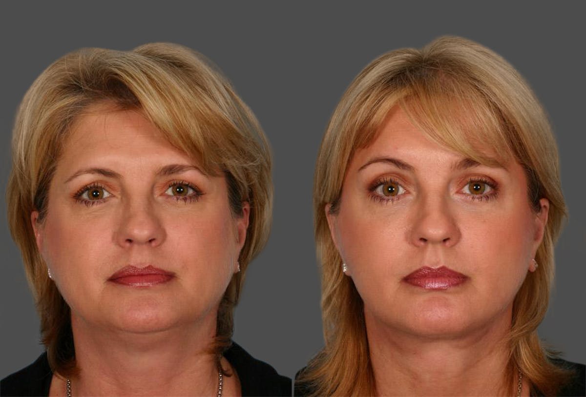 Facelift Before & After Gallery - Patient 264697 - Image 1
