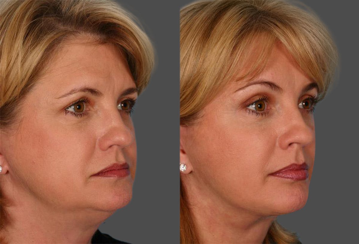 Facelift Before & After Gallery - Patient 264697 - Image 2