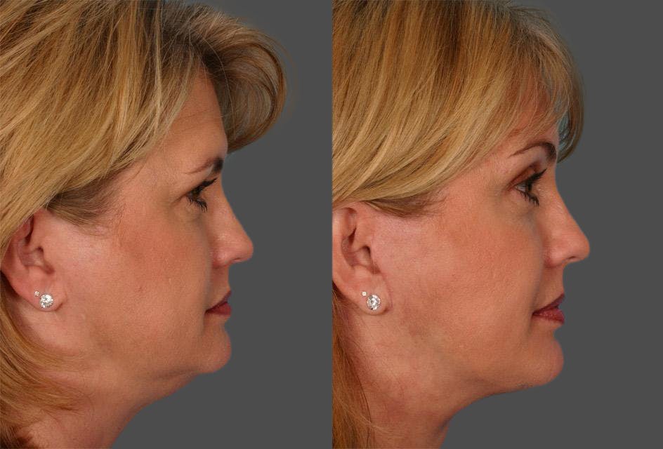 Facelift Before & After Gallery - Patient 264697 - Image 3