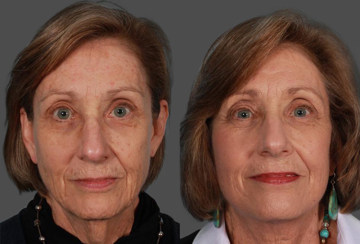 Facelift Before & After Gallery - Patient 262271 - Image 1